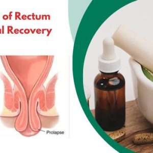 Herbal Treatment of Rectum Prolapse – Natural Recovery Without Surgery - Consult Health Specialists